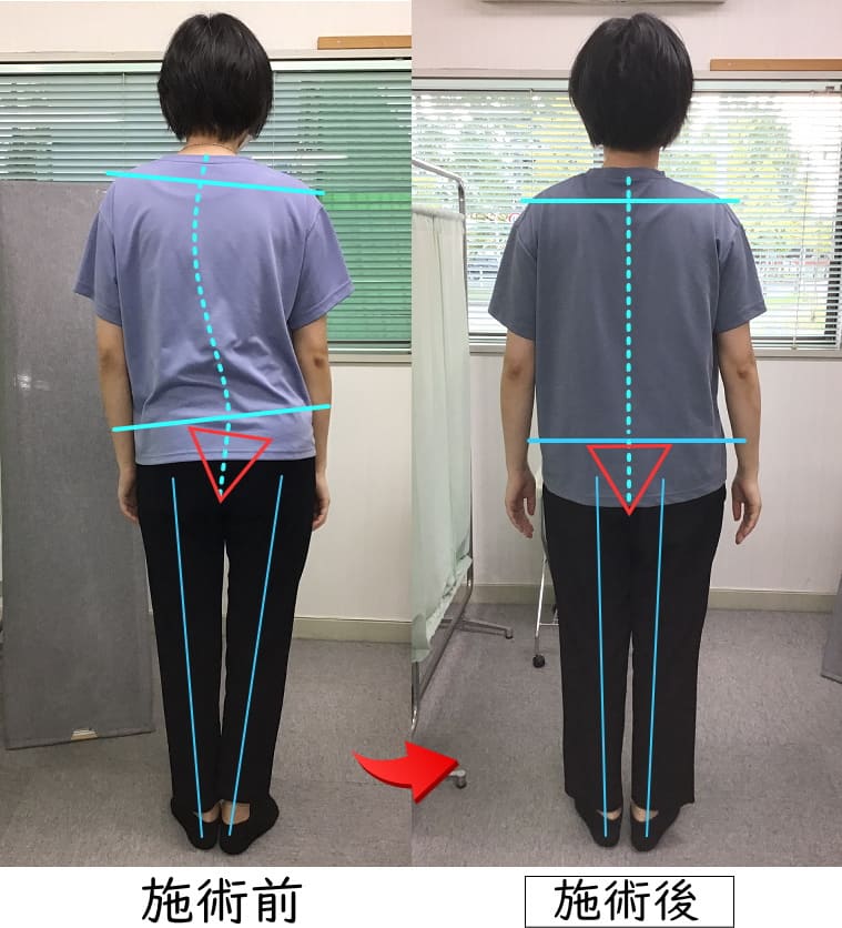 栗原市,　姿勢矯正,側弯症