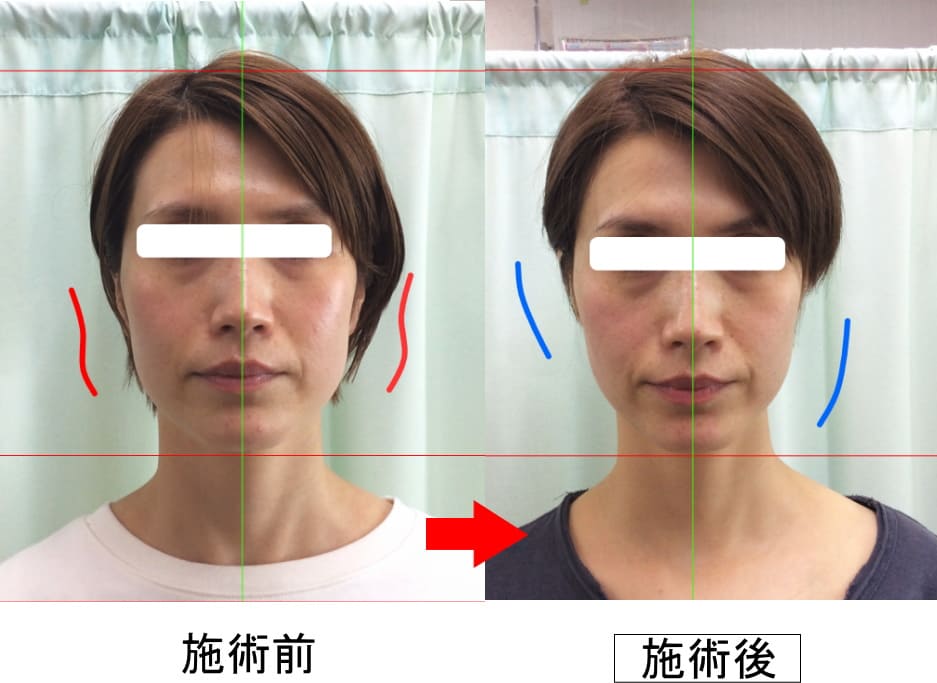 登米市　小顔矯正