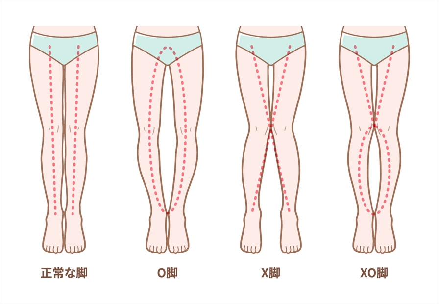 O脚,X脚,XO脚,矯正