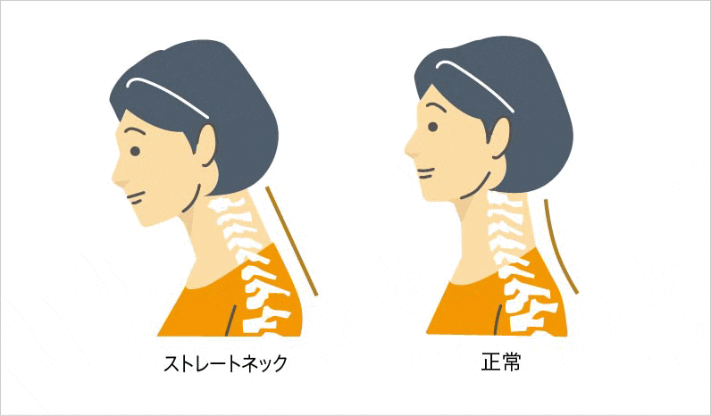 ストレートネック,首痛,整体